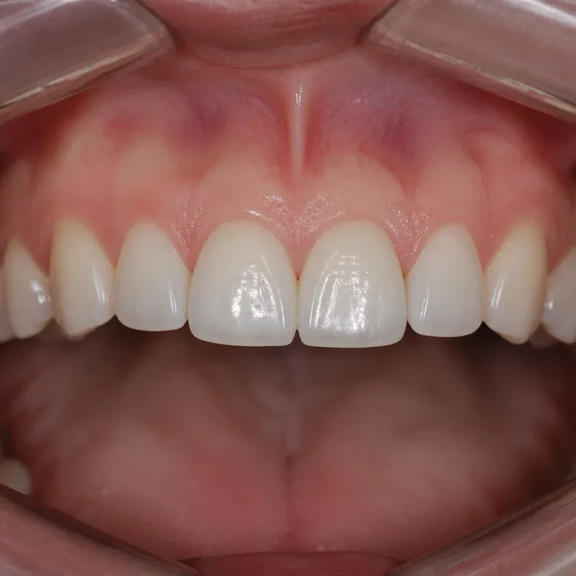 Immediate dental implantation — close-up of the treatment result on a clinical image