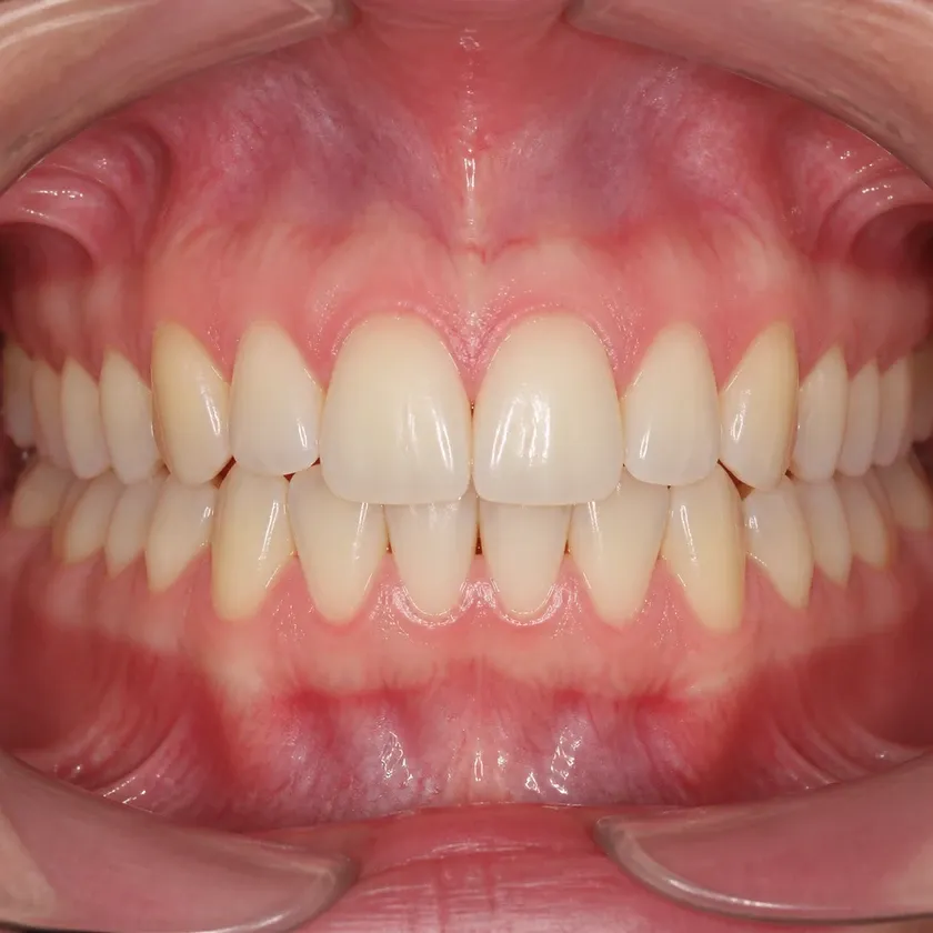 immediate dental implantation in Astana — close-up post-treatment result on a clinical image