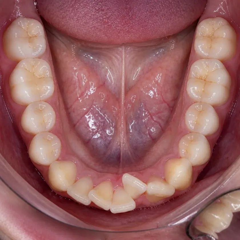 Bite correction surgery — pre-treatment condition on a clinical image
