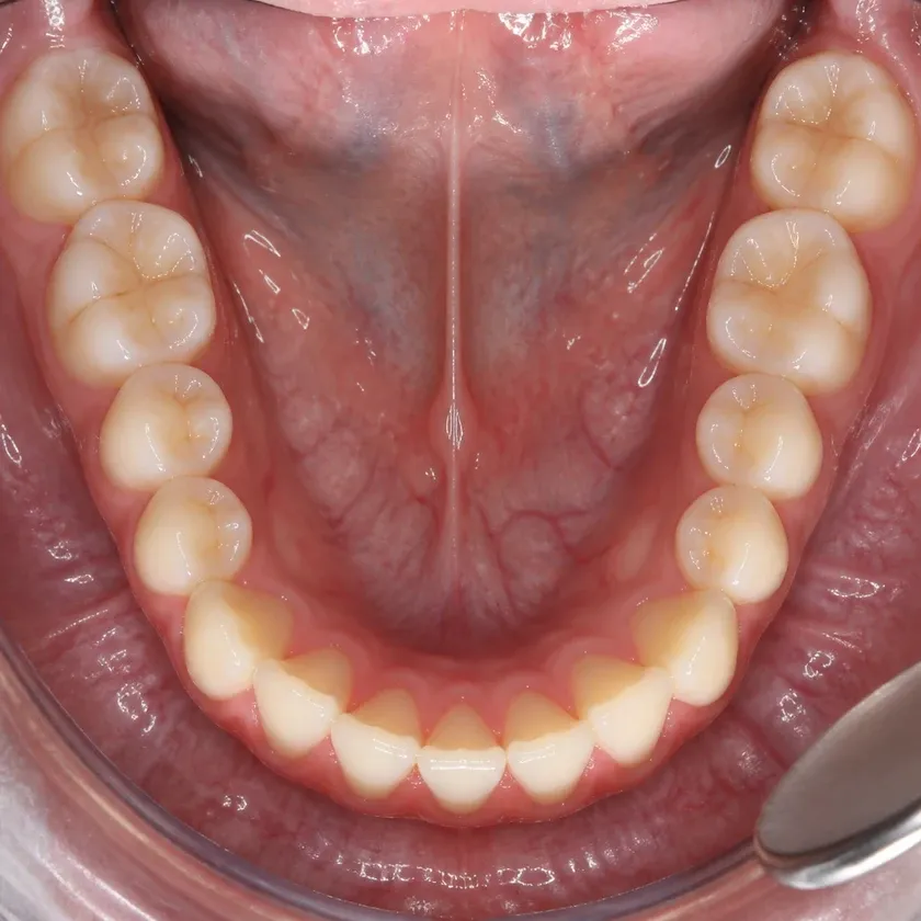 Bite correction surgery — close-up clinical photo of the result after treatment