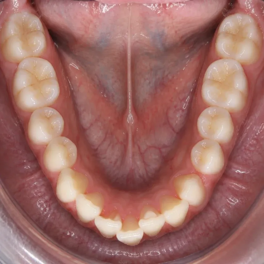 Bite correction surgery — pre-treatment condition on a clinical image