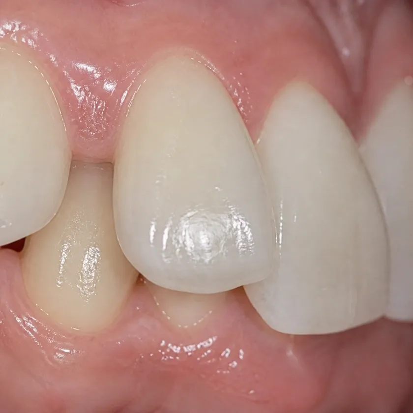 Bite correction surgery — pre-treatment condition on a clinical image