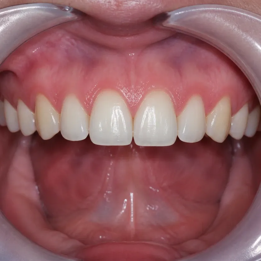 Bite correction surgery — close-up of the result after treatment in a clinical photograph