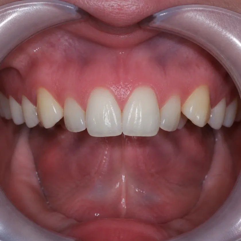 Bite correction surgery — pre-treatment condition on a clinical image