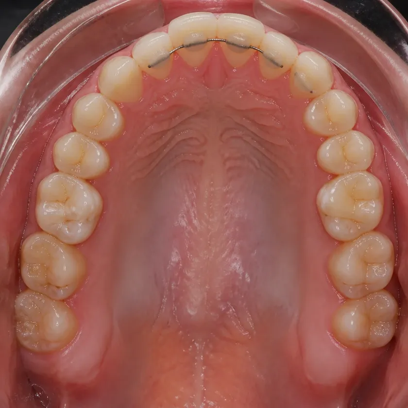 Bite correction surgery — close-up clinical photograph of the result after treatment