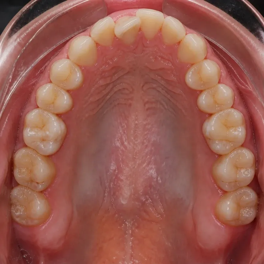 Bite correction surgery — pre-treatment condition on a clinical image