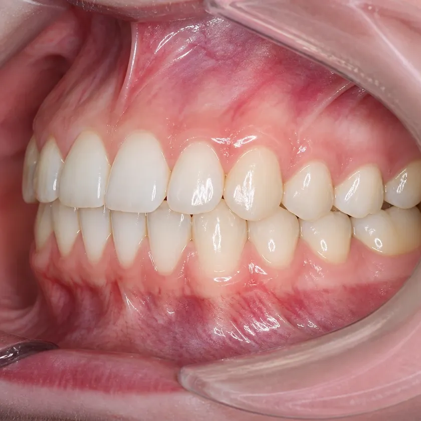 Bite correction surgery — close-up of the treatment result on a clinical image