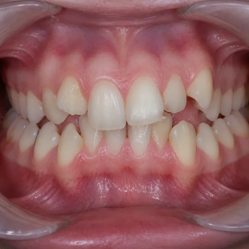 Orthodontics — pre-treatment condition in a clinical photograph