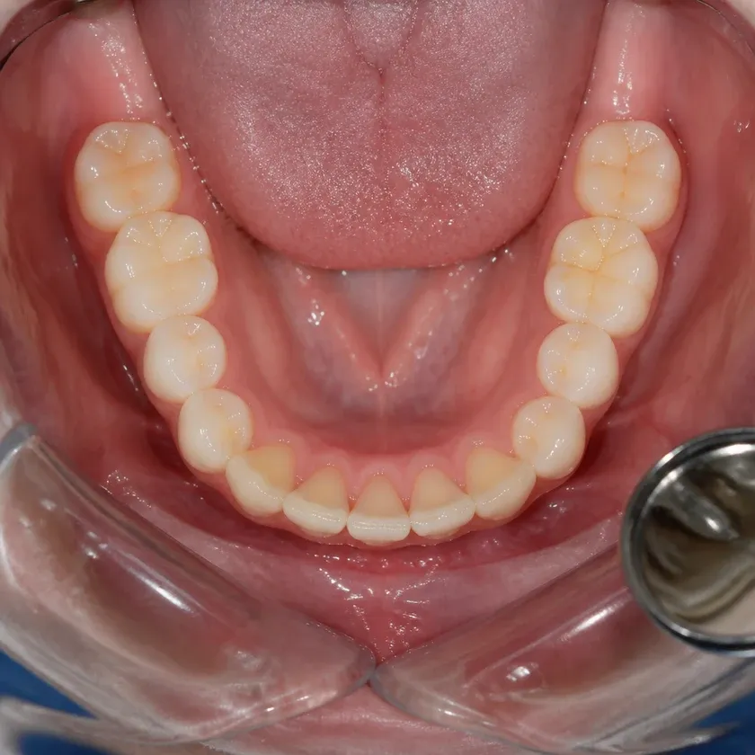 Orthodontics — close-up clinical photograph showing the result after treatment