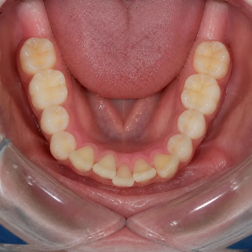 Orthodontics — pre-treatment condition in a clinical photograph