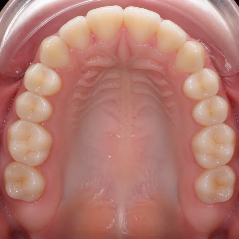 Orthodontics — close-up clinical photograph of the treatment result