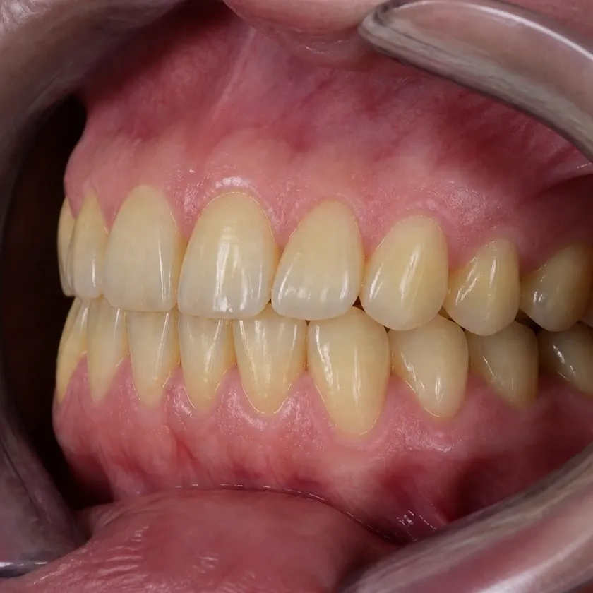 Teeth whitening — before-treatment condition in the clinical photograph
