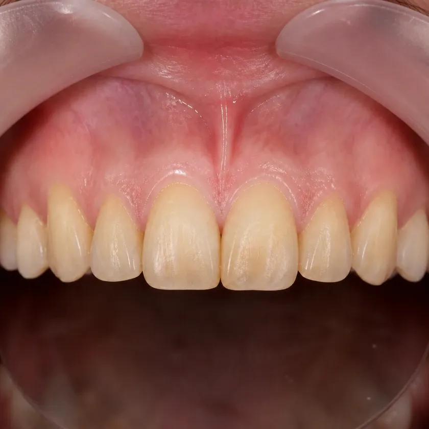 Beyond Polus teeth whitening — before-treatment condition in a clinical photograph