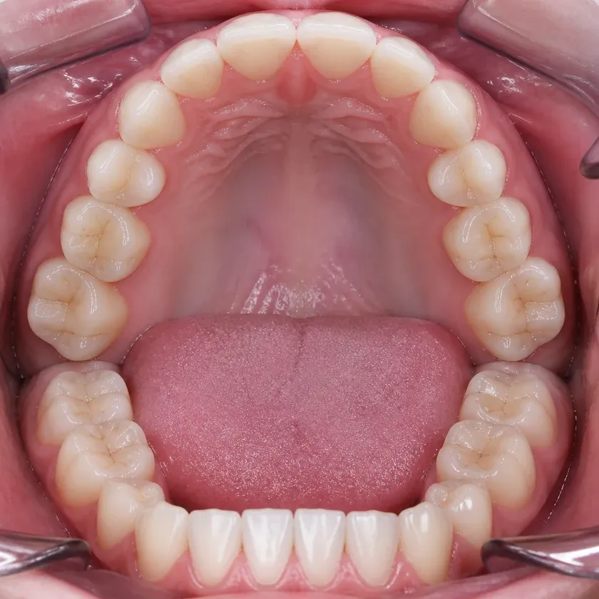 Beyond Polus teeth whitening — close-up clinical photo of the result after treatment