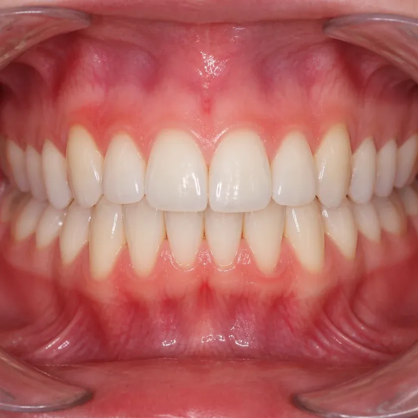 dental appliance — close-up clinical photo of the result after treatment