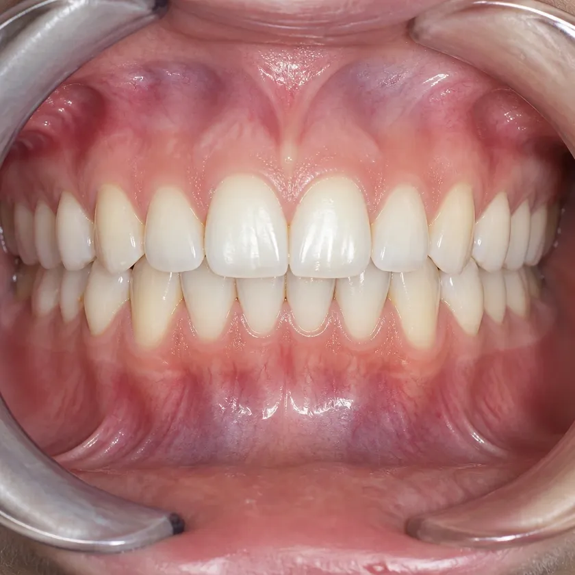 dental appliance — close-up clinical photo of the result after treatment