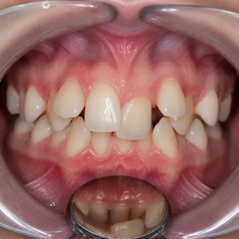 Dental veneers — before treatment, clinical photograph