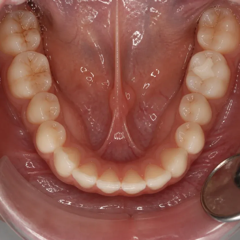 Root canal filling — close-up clinical image of the result after treatment