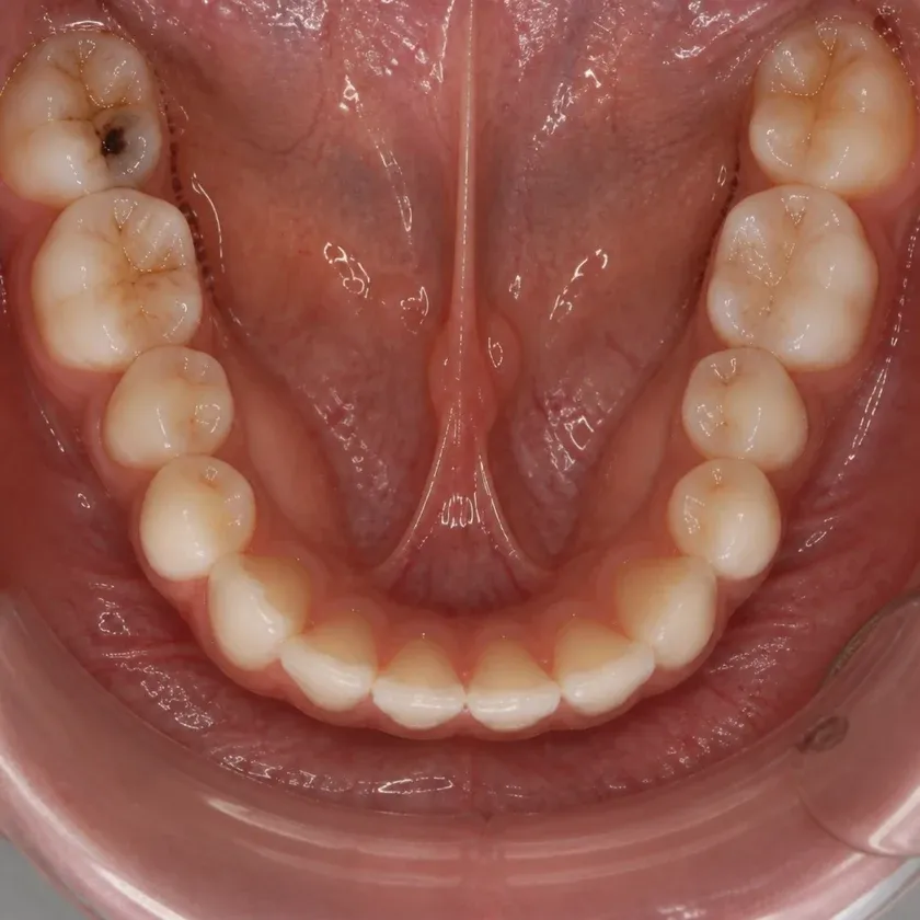 Root canal filling — pre-treatment condition on clinical image