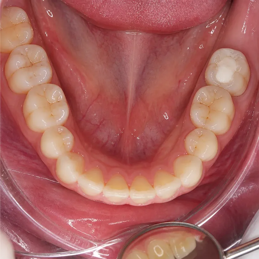 Root canal filling — close-up clinical image of the result after treatment