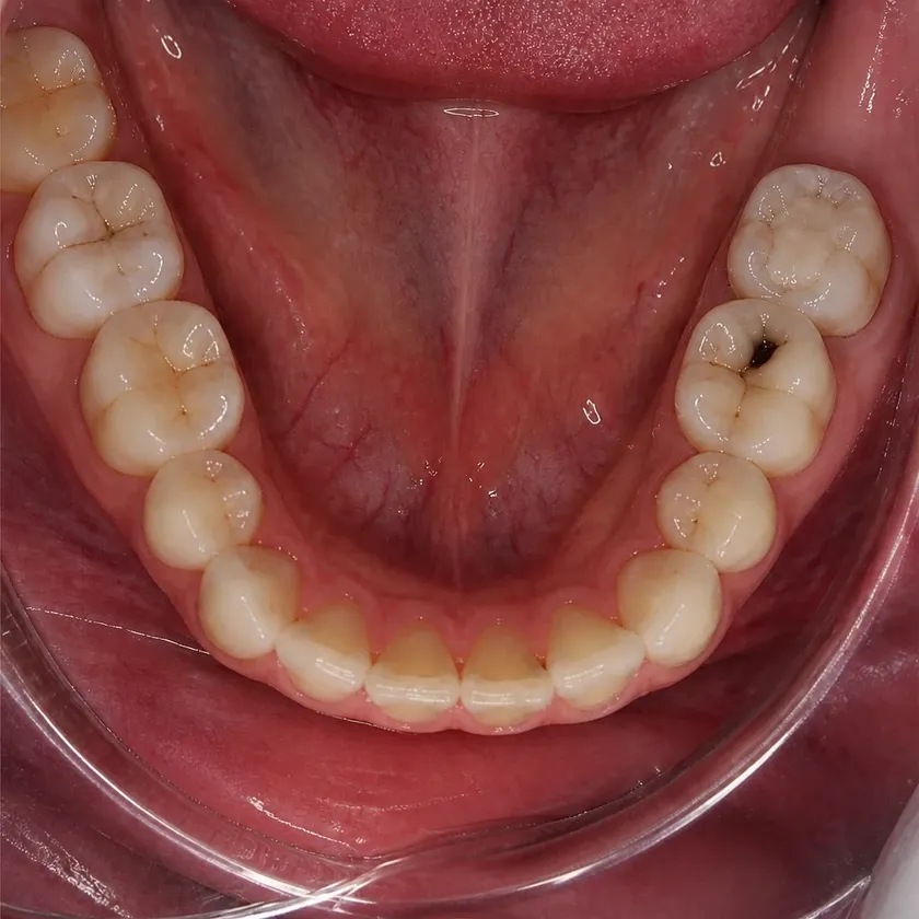 Root canal filling — pre-treatment condition on clinical image