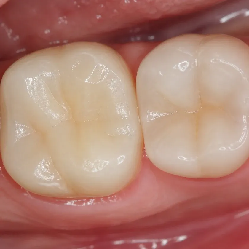 Root canal filling — close-up clinical image of the treatment result