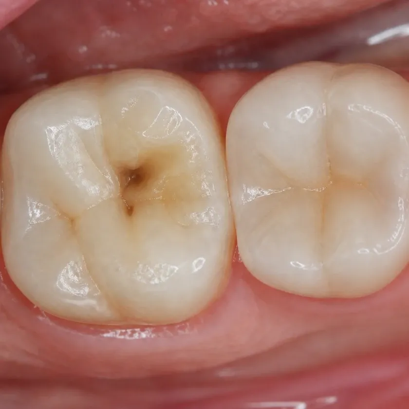 Root canal filling — pre-treatment condition on clinical image