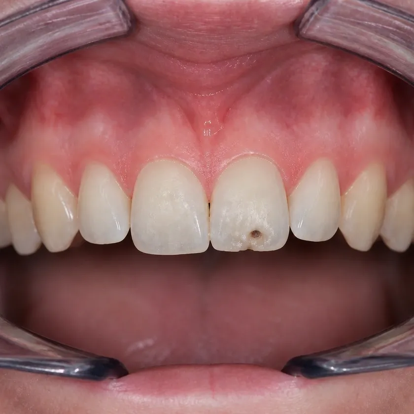 Root canal filling — pre-treatment condition on clinical image