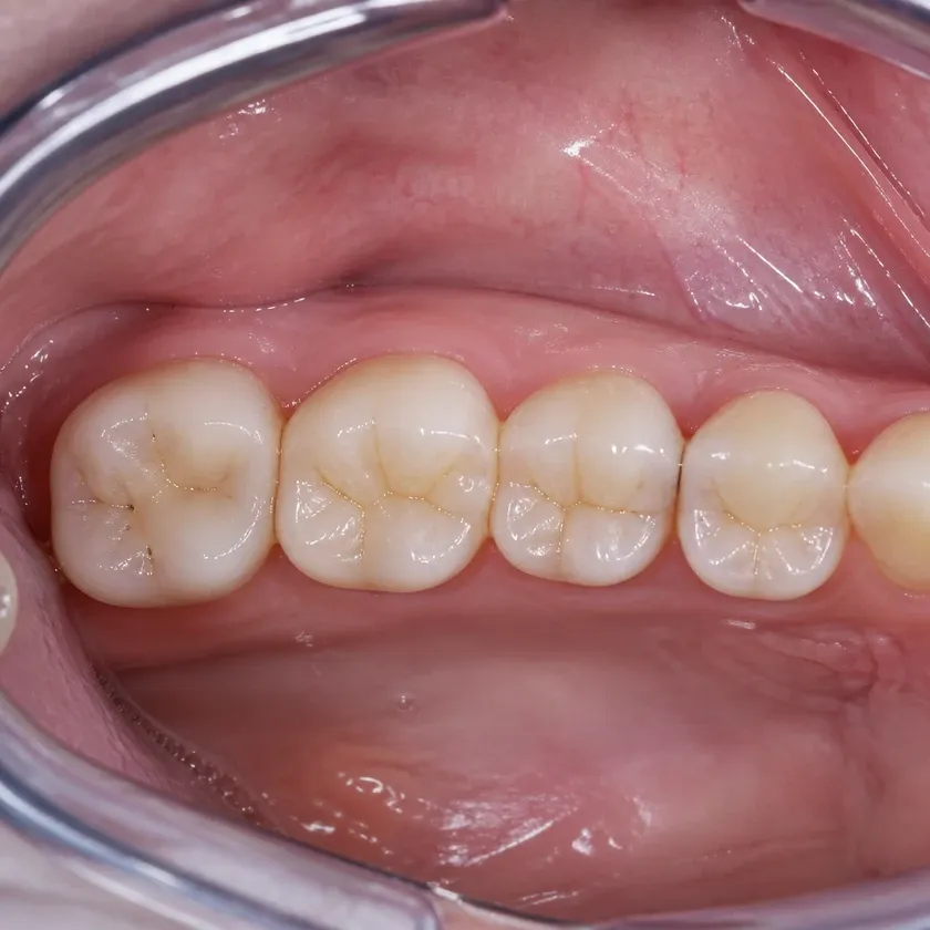 Root canal filling — post-treatment close-up on a clinical image