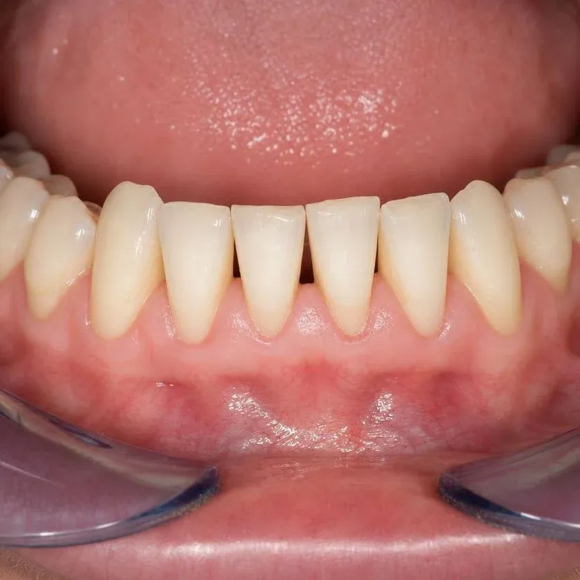Clean lower incisors after scaling