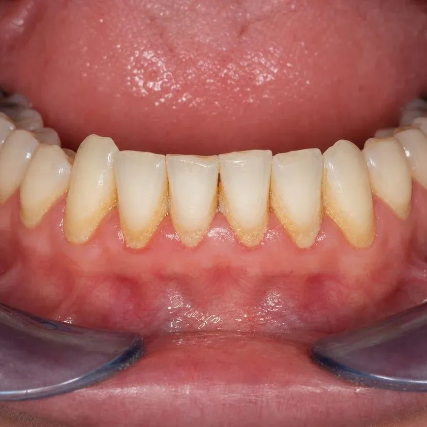 Heavy calculus deposits on the lower incisors before cleaning