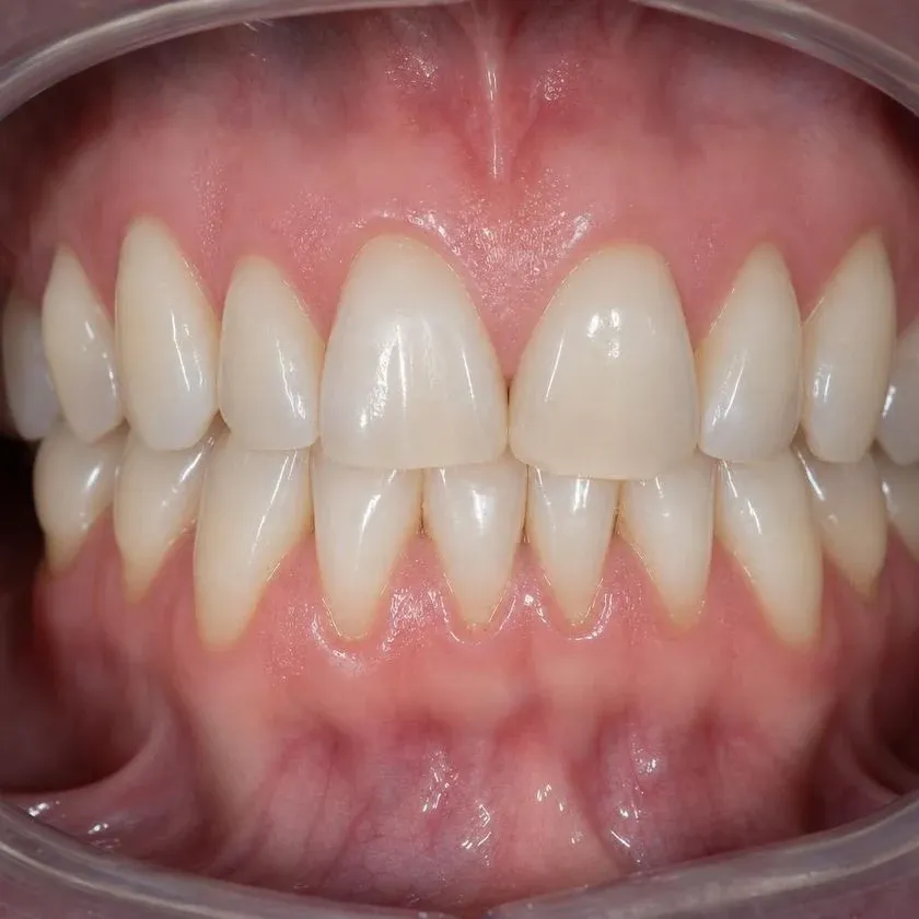 Light enamel of the front teeth after Air Flow