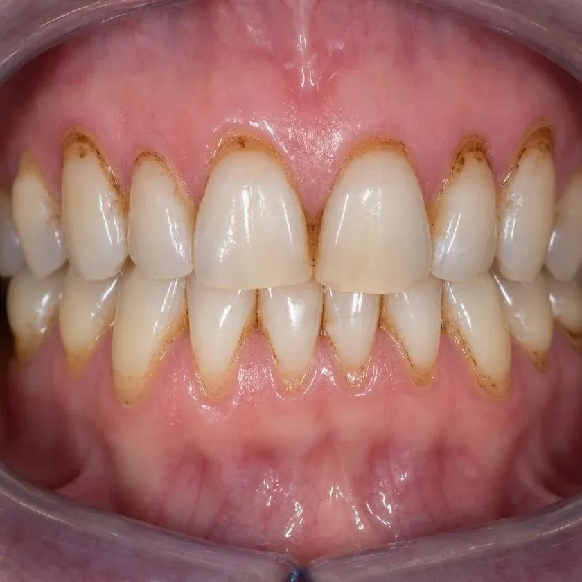 Dark staining from coffee and cigarettes on the front teeth