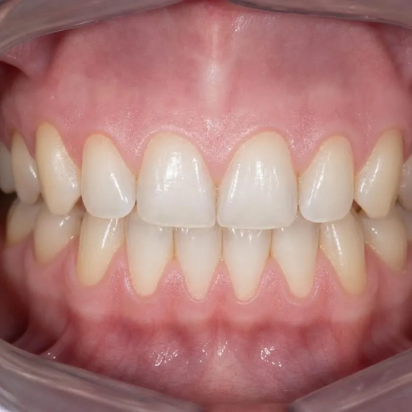 Healthy pale pink gums after hygiene