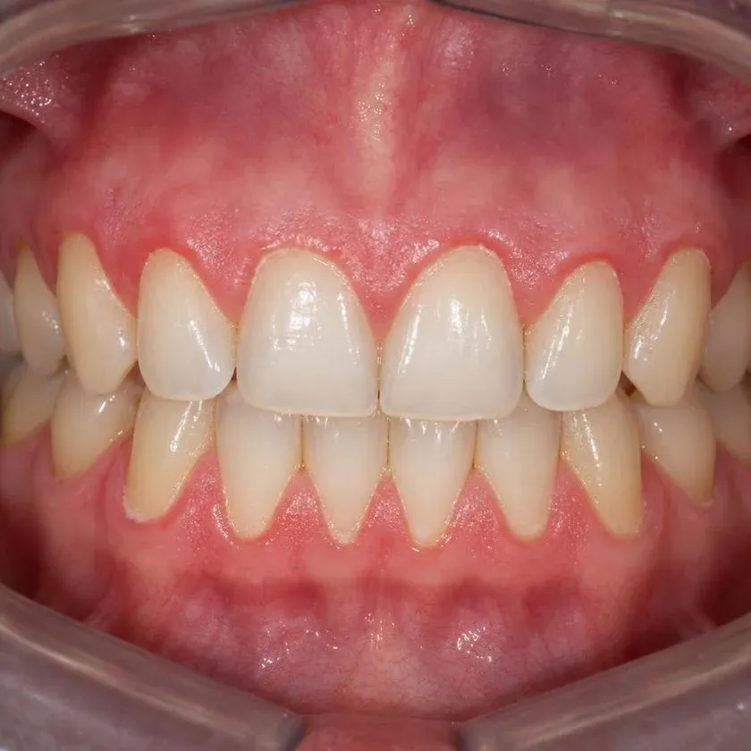 Inflamed bleeding gums with soft plaque