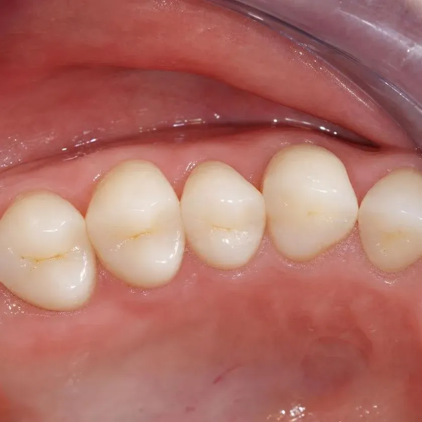 Clean tooth necks after polishing