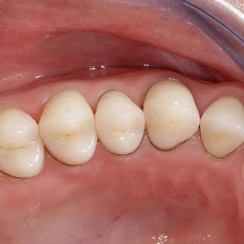 Dark pigmented rim at the gingival margin