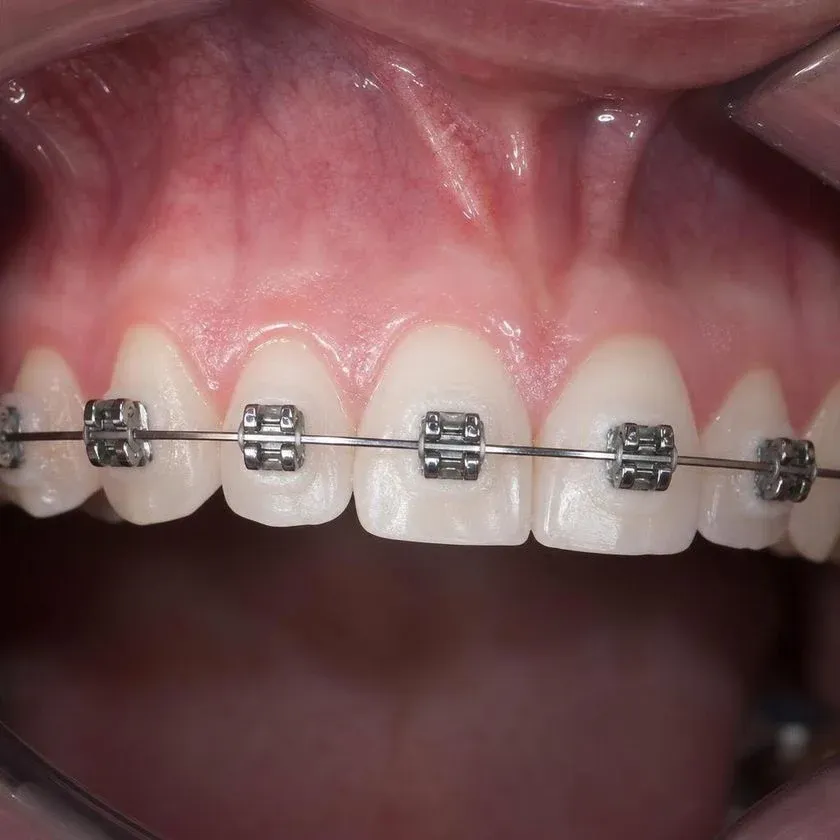 Clean enamel around braces after hygiene