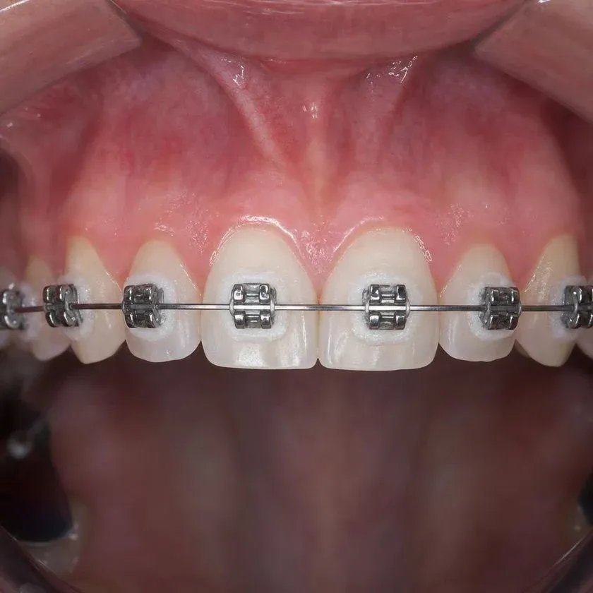 Soft plaque around braces on upper teeth