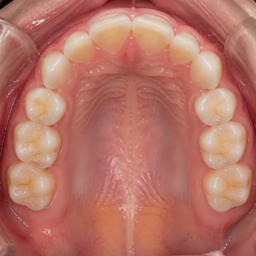 Professional teeth cleaning for children — close-up clinical image of the result after treatment