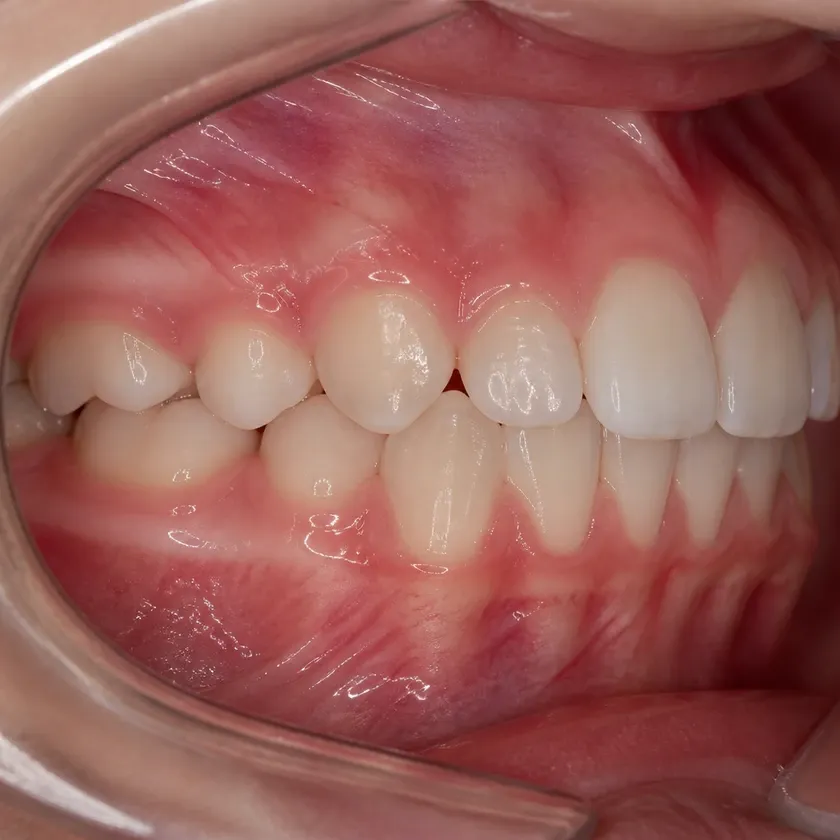 Professional teeth cleaning for children — close-up clinical image showing the result after treatment