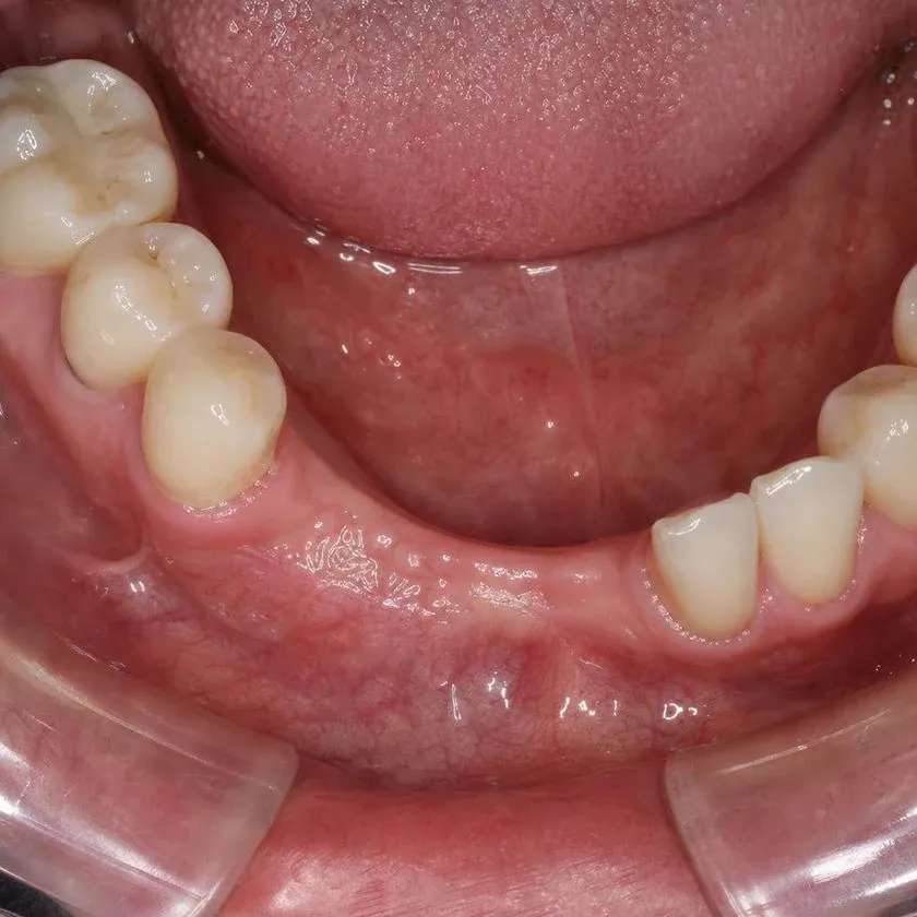 Edentulous space at the site of three extracted teeth