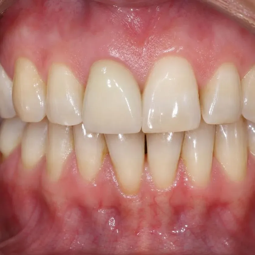 All-ceramic crown with no dark margin at the gum line