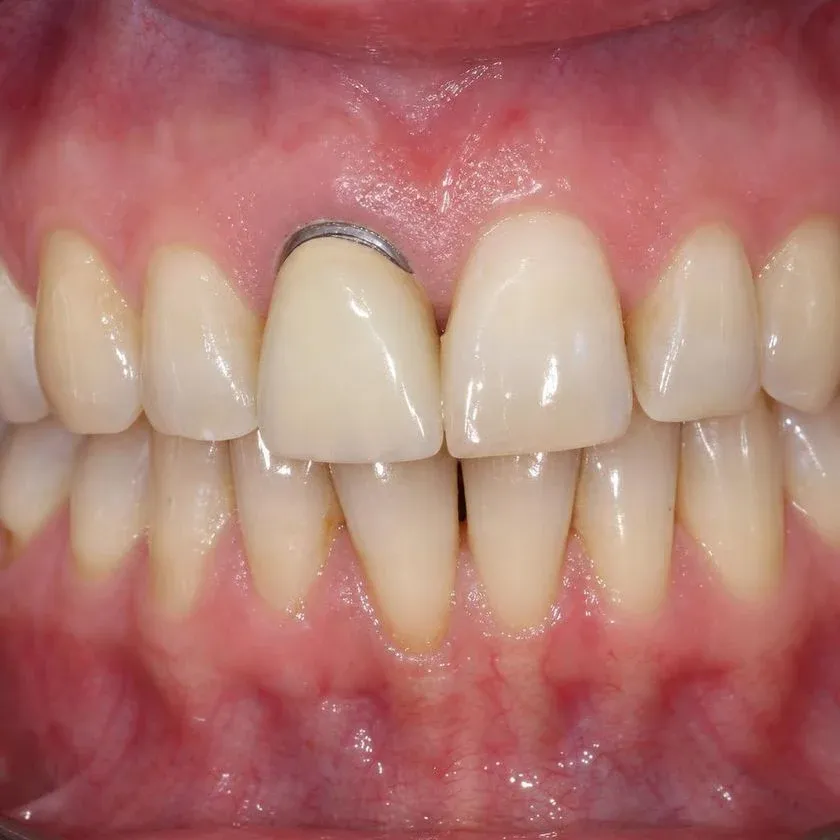 Old porcelain-fused-to-metal crown with a dark margin at the gum line