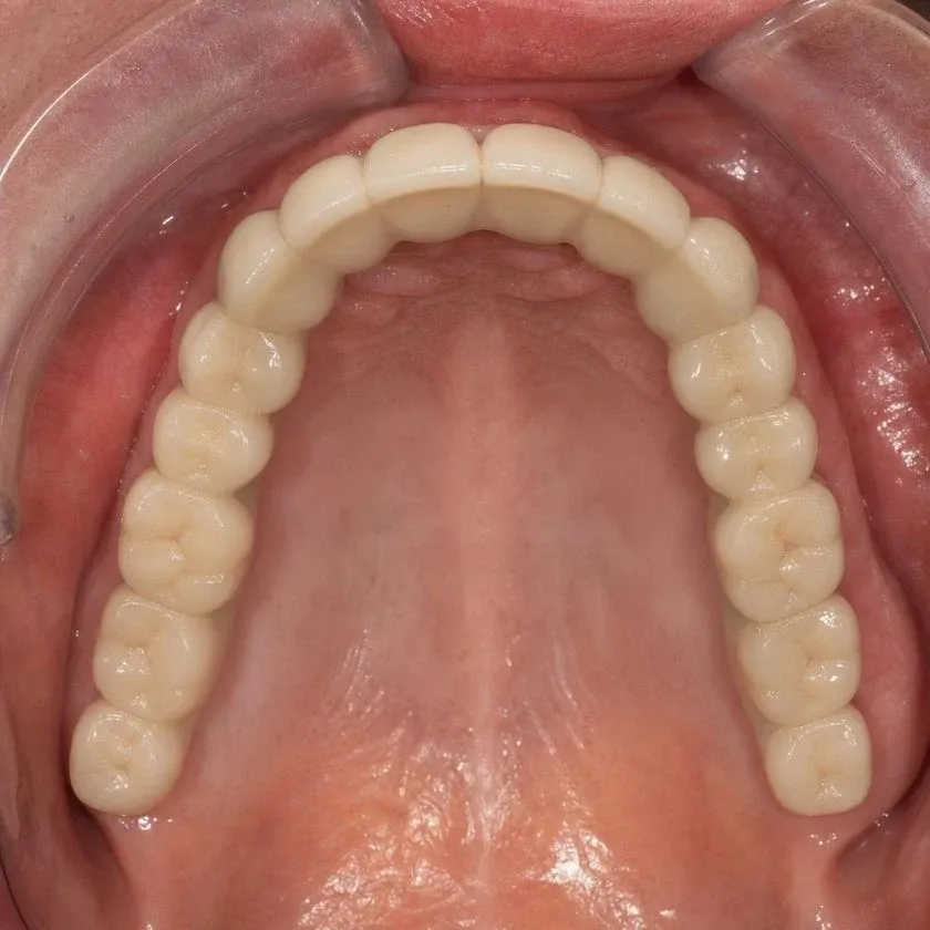 Full fixed implant-supported maxillary denture