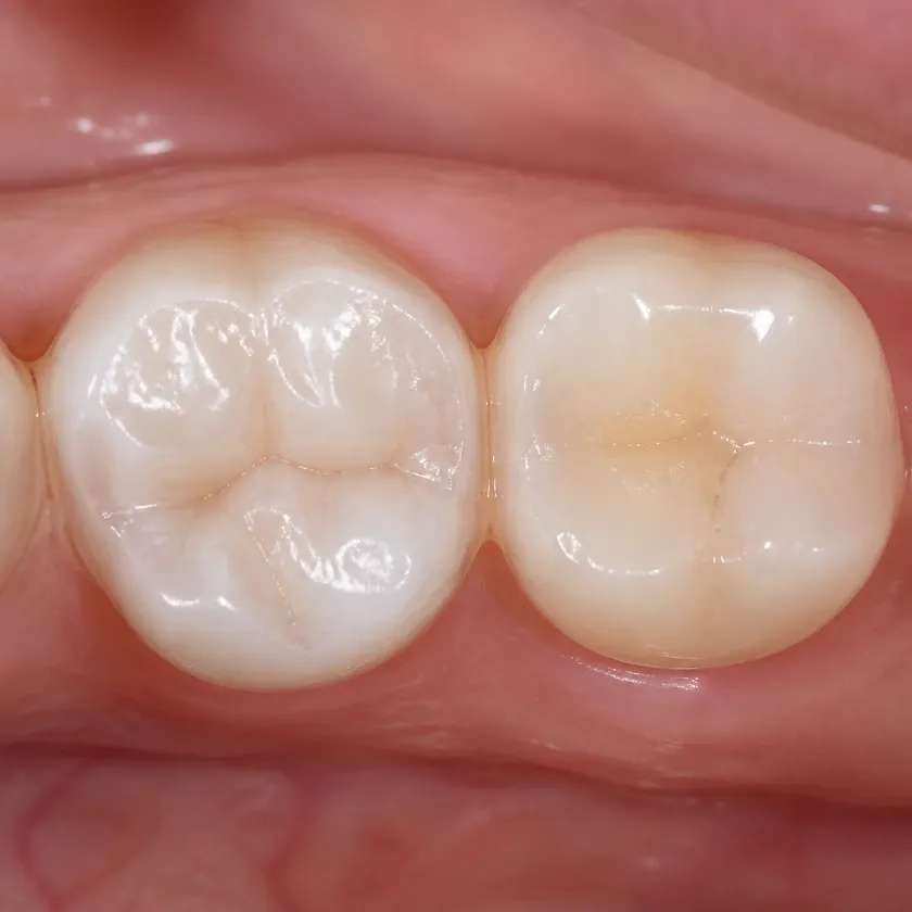 Dental prosthetics — close-up of the treatment result in a clinical photograph