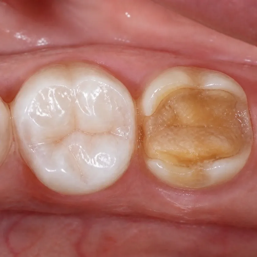 Dental prosthetics — pre-treatment condition on a clinical image