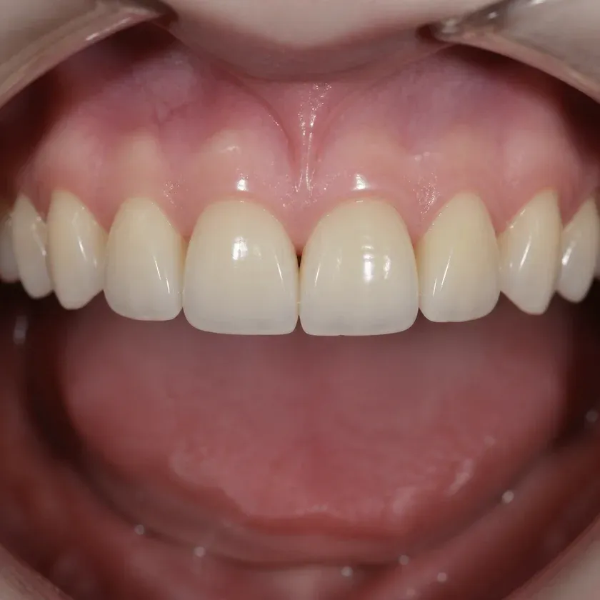 Dental prosthetics — close-up of the treatment result in a clinical photograph