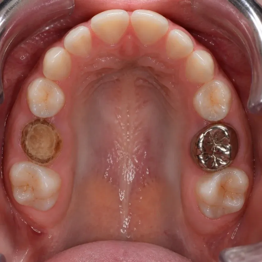 Pediatric dental prosthetics — pre-treatment condition on a clinical image