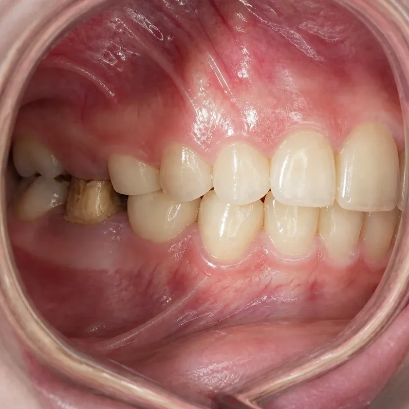 Pediatric dental prosthetics — pre-treatment condition on a clinical image